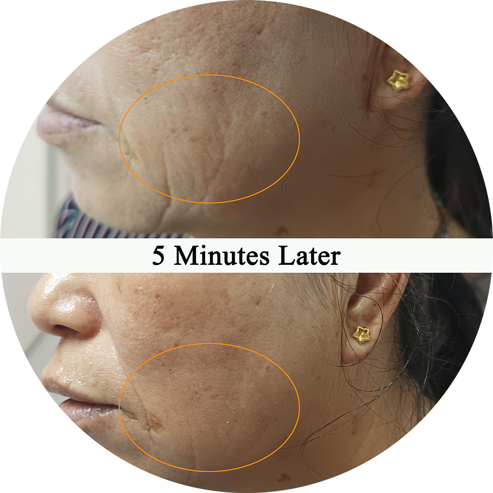 Before and after skin treatment results - 5 minutes later
